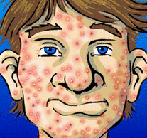 http://gavwebclass.com/fall209/ppettie/acne_cartoon.png