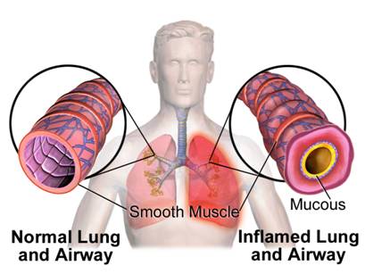 http://upload.wikimedia.org/wikipedia/commons/9/92/Blausen_0620_Lungs_NormalvsInflamedAirway.png